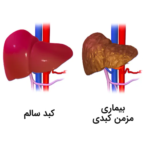 استفاده از داروی اواترومبوپگ در بیماری های مزمن کبدی